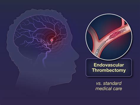 large ischemic stroke thrombectomy